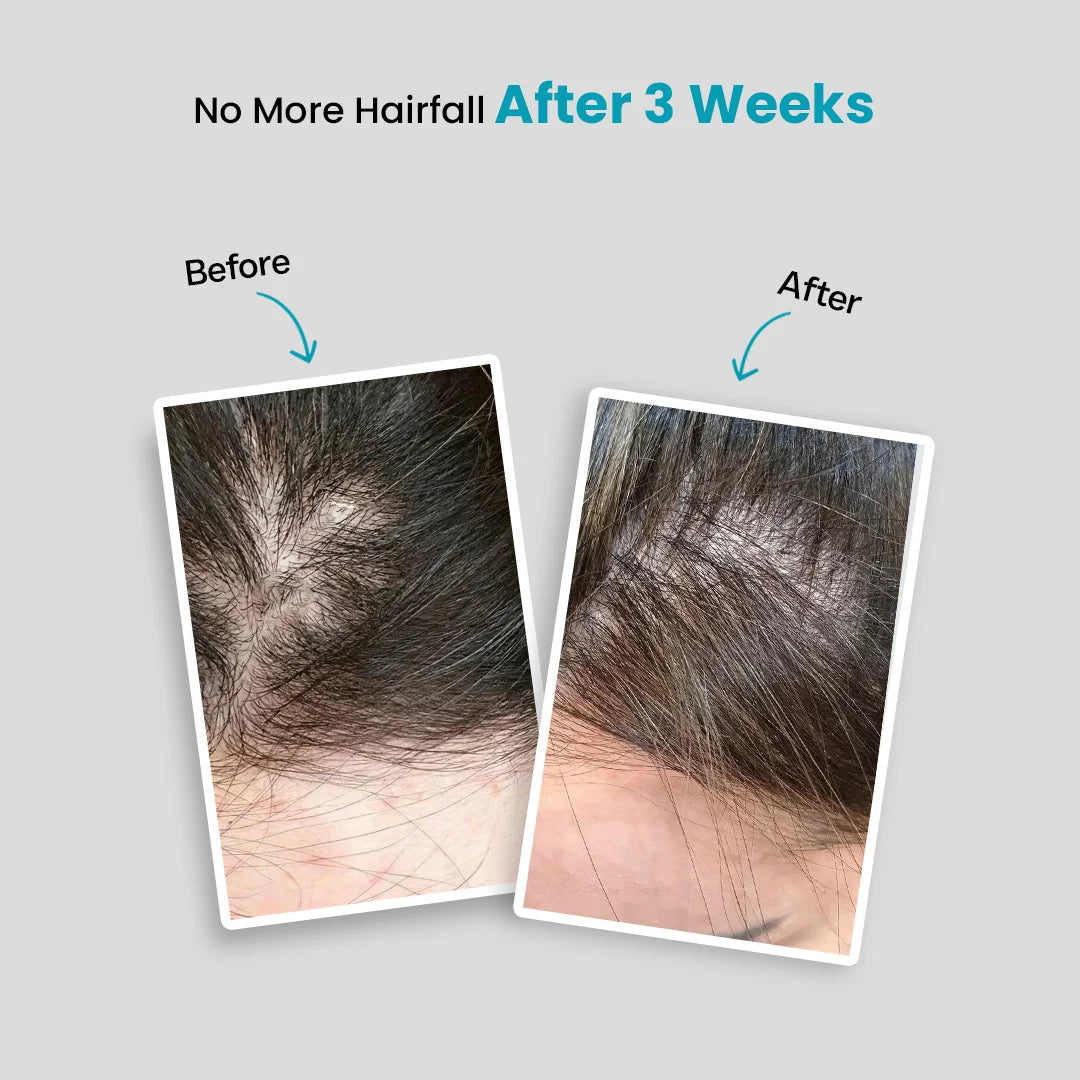 21-Day Hair Fall Control Challenge Kit